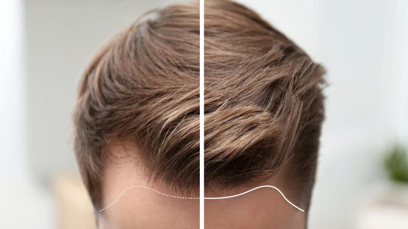 „STAY SAFE PLUS“ - RUNDUM-PFLEGE NACH IHRER HAARTRANSPLANTATION